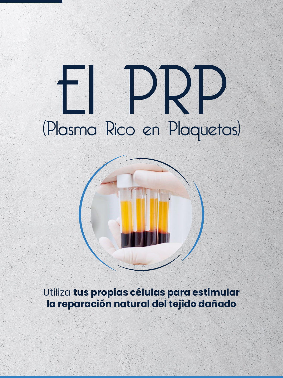 El PRP (plasma rico en plaquetas) utiliza componentes de tu propia sangre como parte del tratamiento del tejido dañado