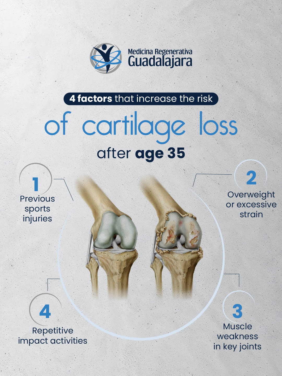 Factores que aumentan el riesgo de pérdida de cartílago después de los 35 años: lesiones deportivas previas, sobrepeso, debilidad muscular e impacto repetitivo